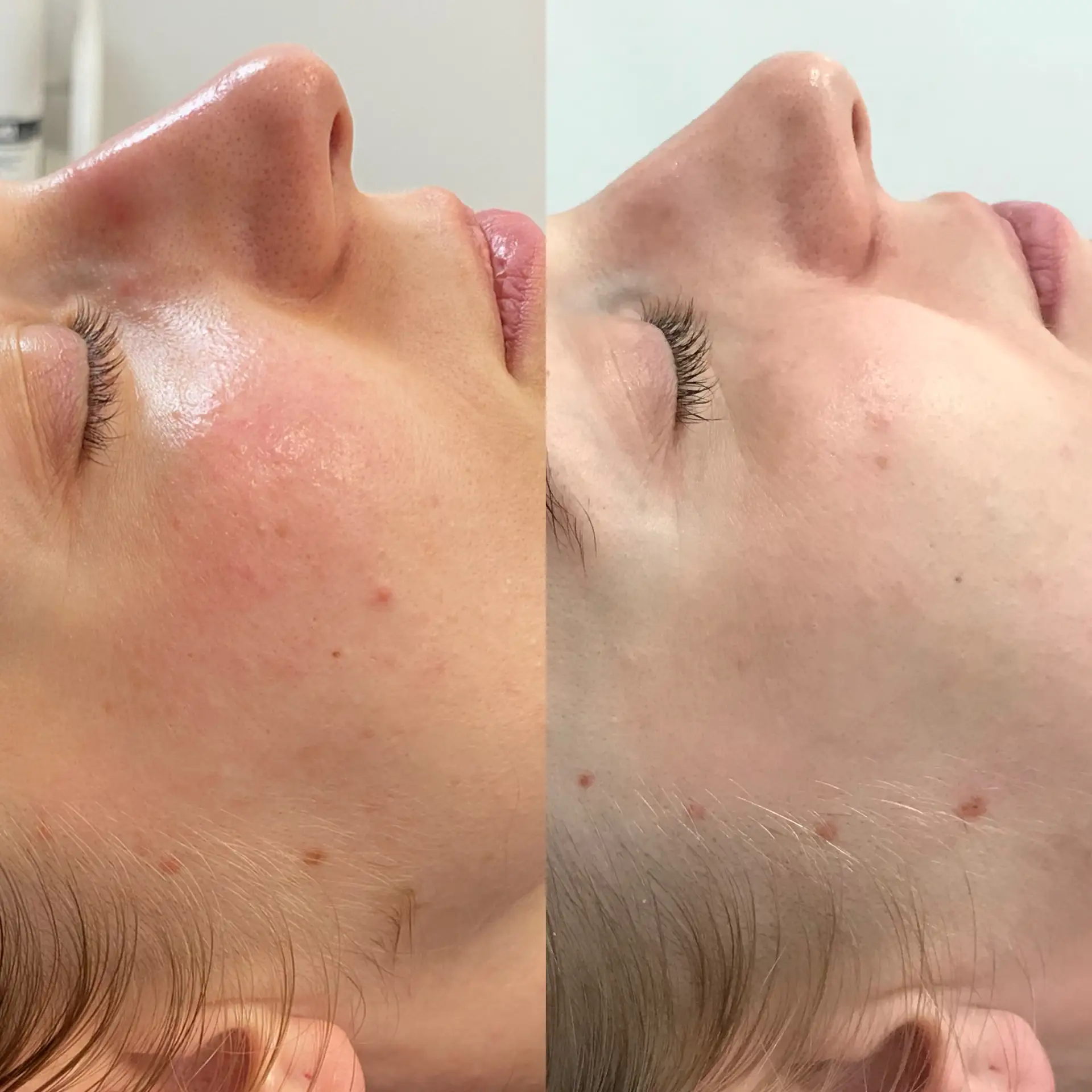 Efekty zabiegu poprawa tekstury i kolorytu Płock