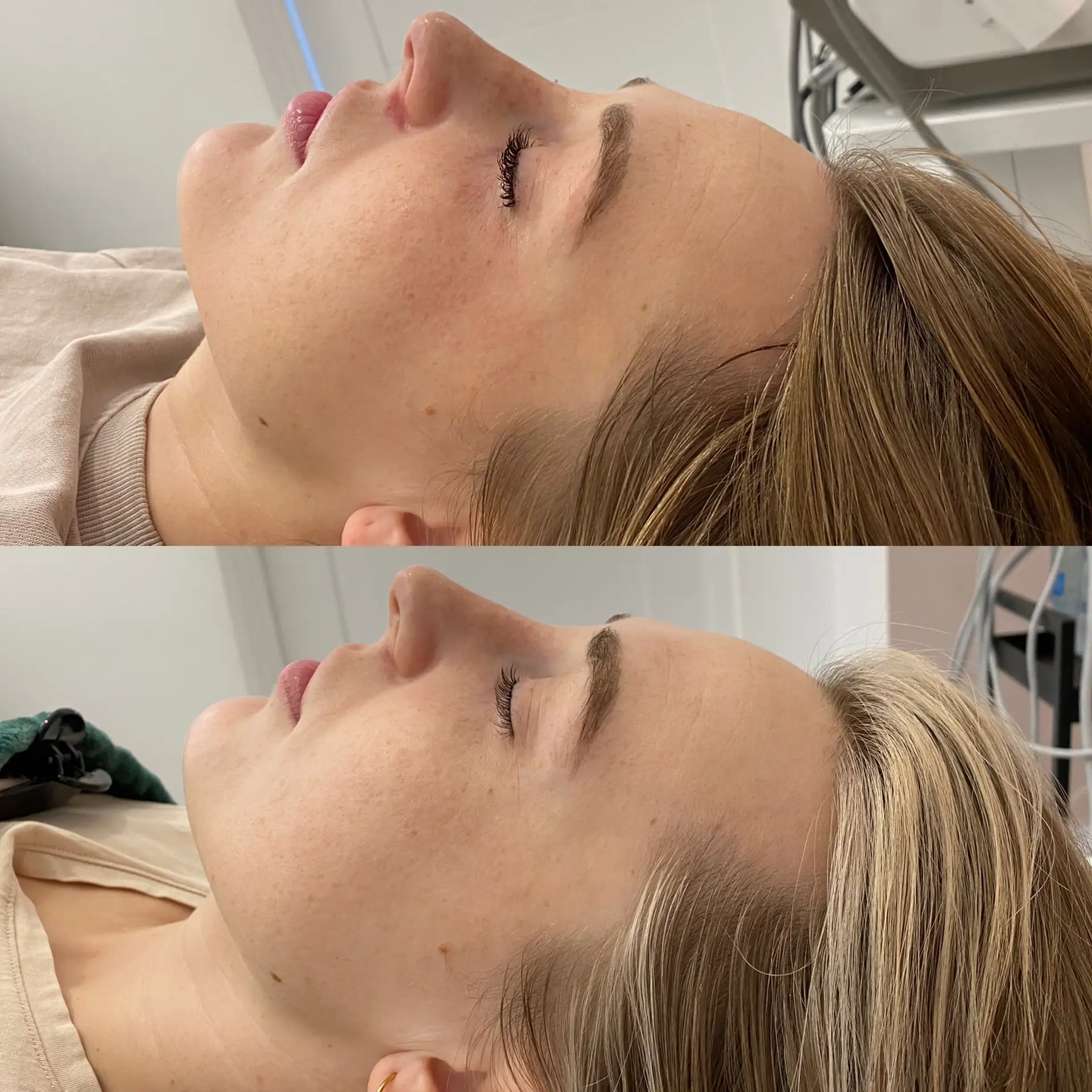 Zabieg odmładzający poprawa jędrności Płock